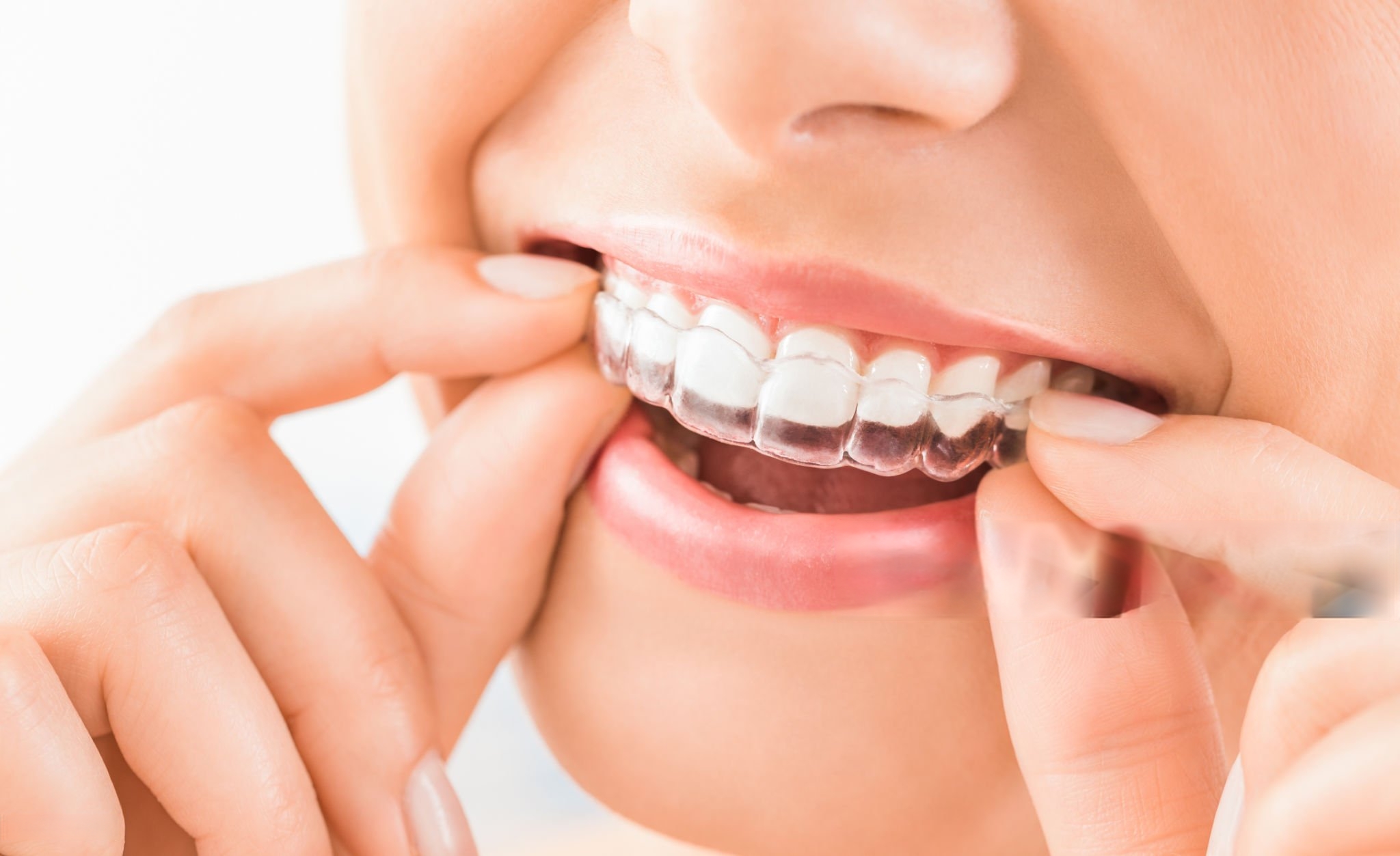 Invisalign Offer