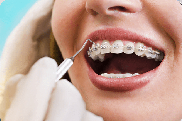 Orthodontic Treatments